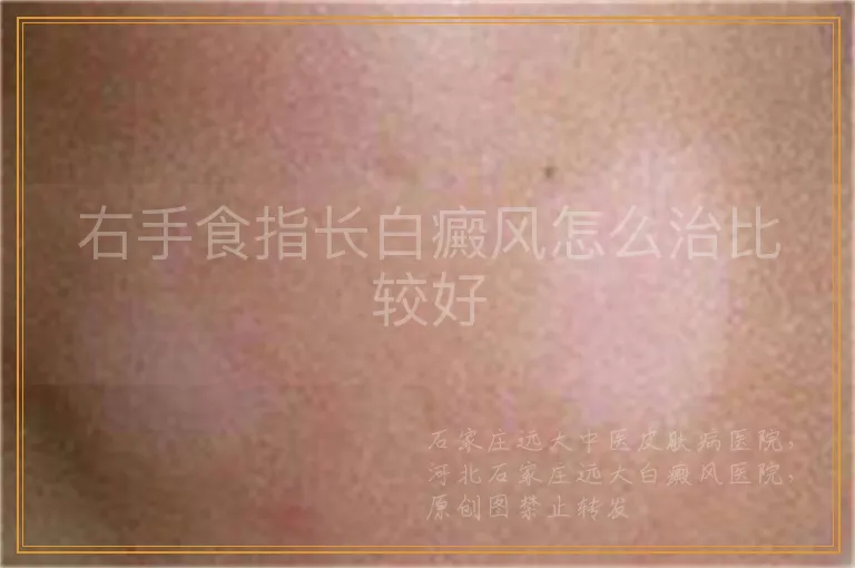 右手食指长白癜风怎么治比较好