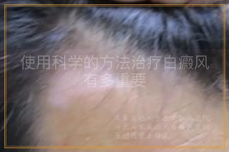 使用科学的方法治疗白癜风有多重要