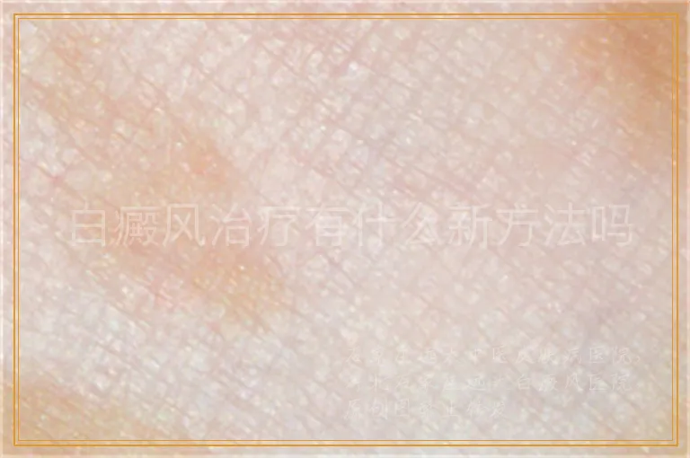 白癜风治疗有什么新方法吗