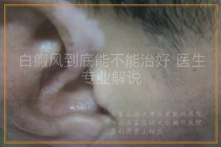 白癜风到底能不能治好 医生专业解说