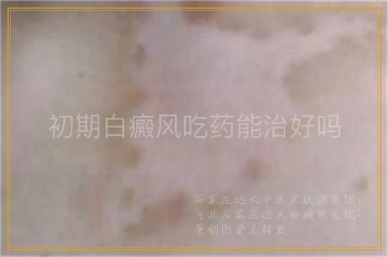 初期白癜风吃药能治好吗