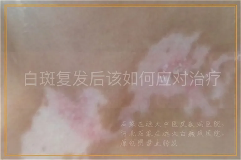 白斑复发后该如何应对治疗