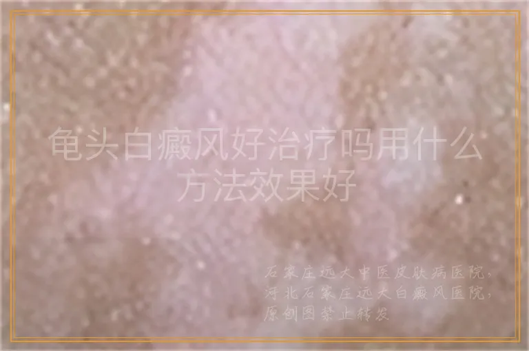 龟头白癜风好治疗吗用什么方法效果好