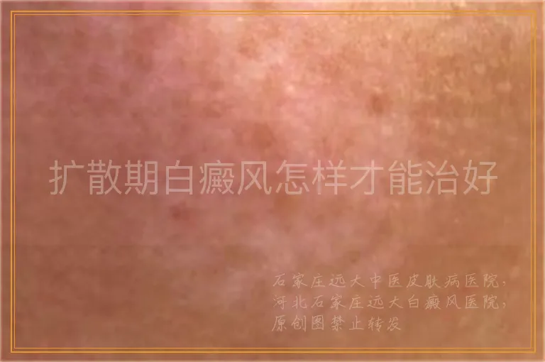 扩散期白癜风怎样才能治好