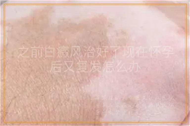 之前白癜风治好了现在怀孕后又复发怎么办