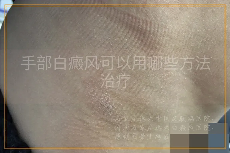 手部白癜风可以用哪些方法治疗