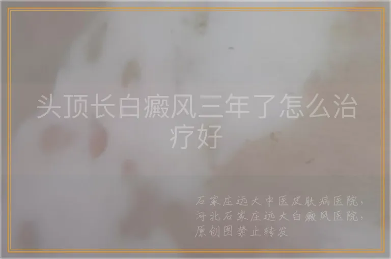 头顶长白癜风三年了怎么治疗好