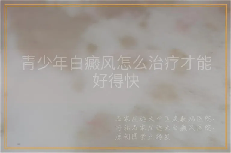 青少年白癜风怎么治疗才能好得快