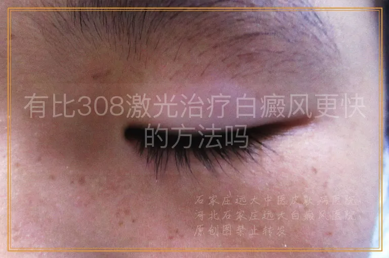 有比308激光治疗白癜风更快的方法吗