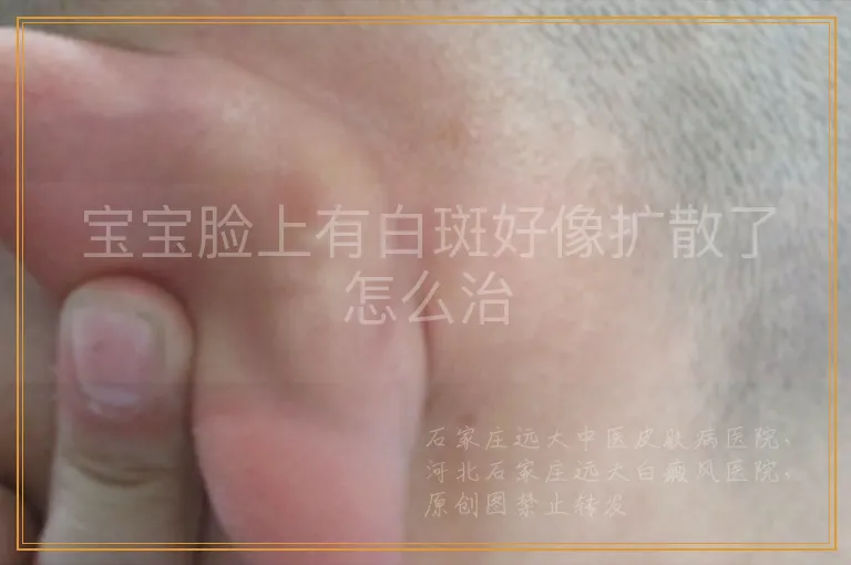 宝宝脸上有白斑好像扩散了怎么治