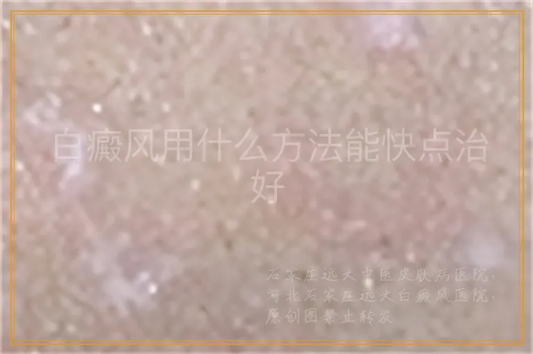 白癜风用什么方法能快点治好