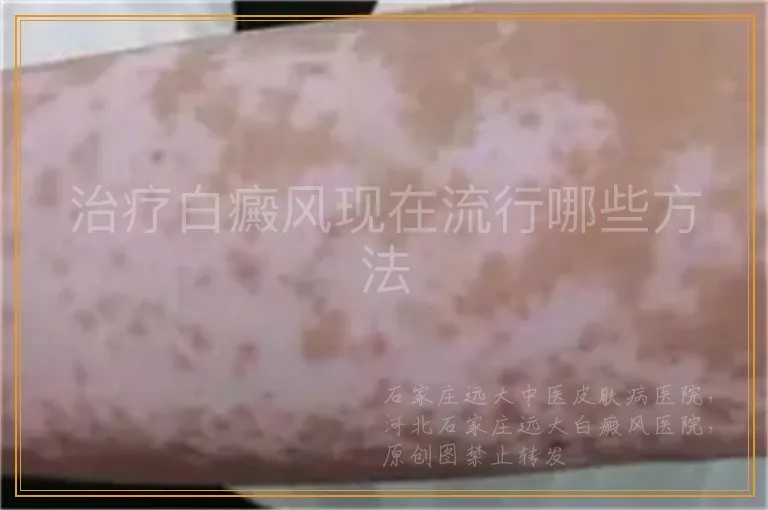 治疗白癜风现在流行哪些方法
