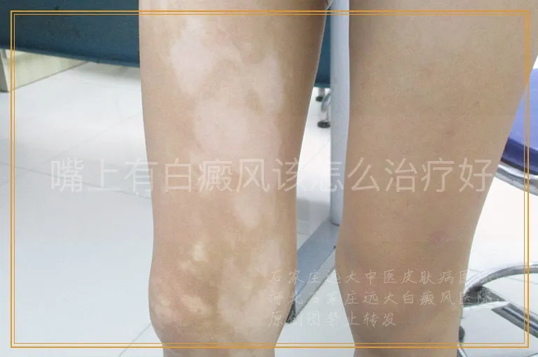 嘴上有白癜风该怎么治疗好