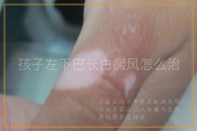 孩子左下巴长白癜风怎么治