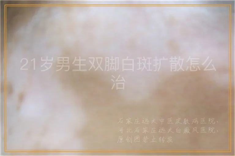 21岁男生双脚白斑扩散怎么治