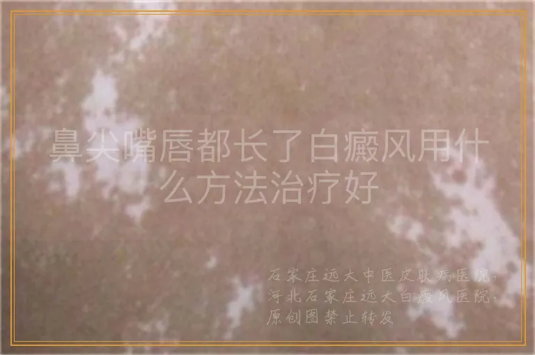 鼻尖嘴唇都长了白癜风用什么方法治疗好