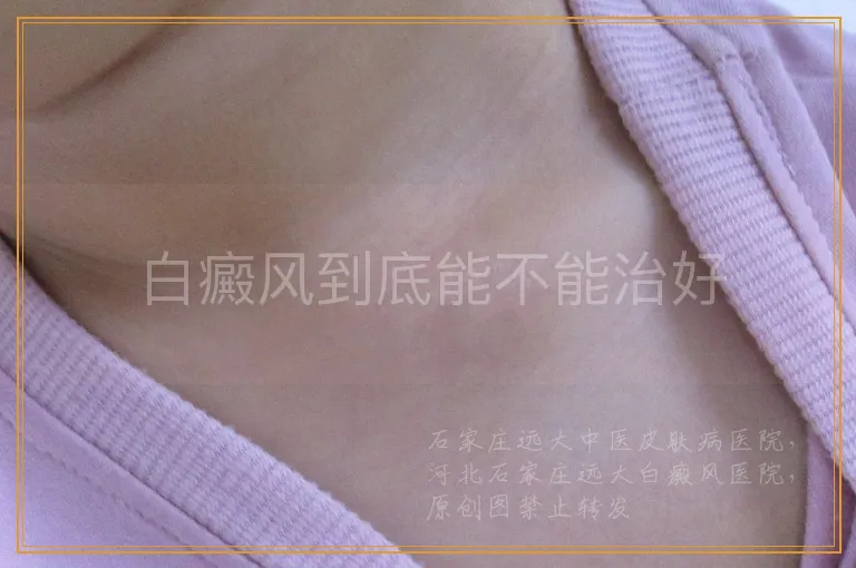 白癜风到底能不能治好