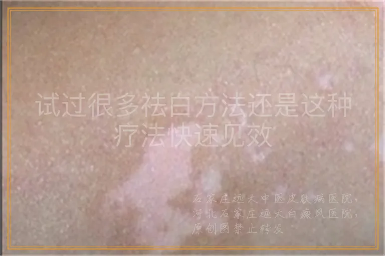 试过很多祛白方法还是这种疗法快速见效