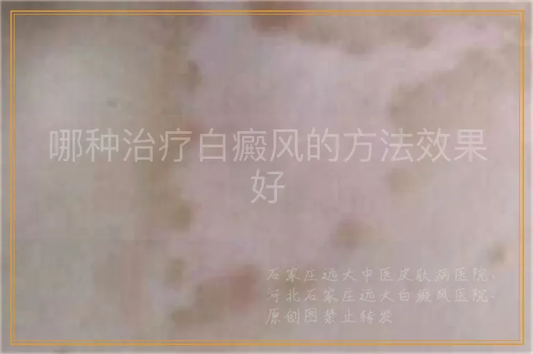 哪种治疗白癜风的方法效果好
