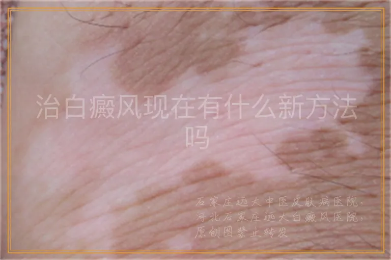 治白癜风现在有什么新方法吗