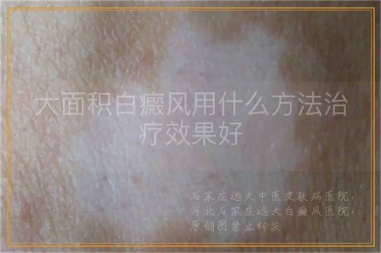 大面积白癜风用什么方法治疗效果好