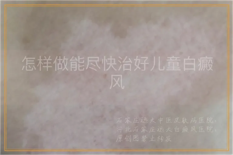 怎样做能尽快治好儿童白癜风