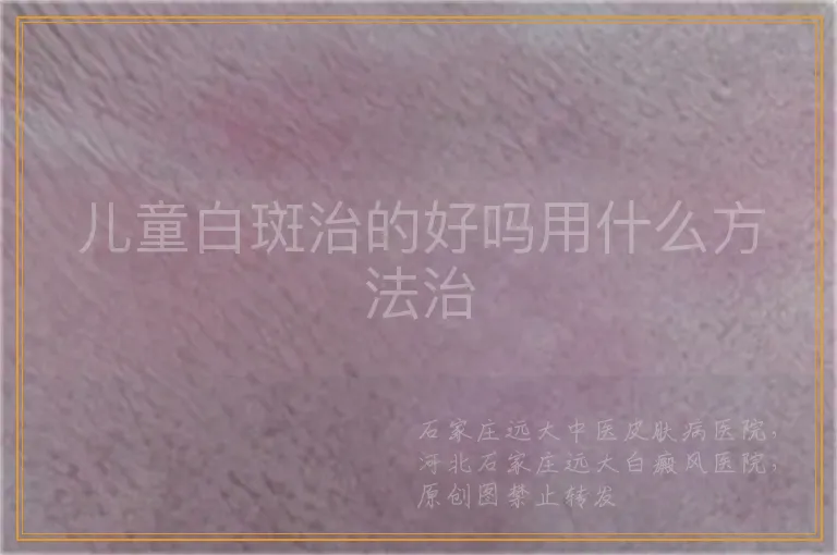 儿童白斑治的好吗用什么方法治