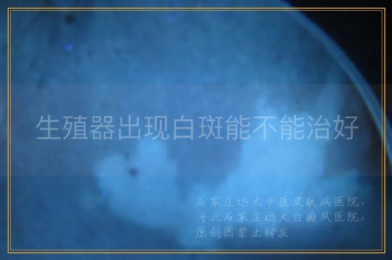 生殖器出现白斑能不能治好