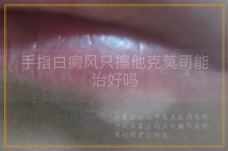 手指白癜风只擦他克莫司能治好吗