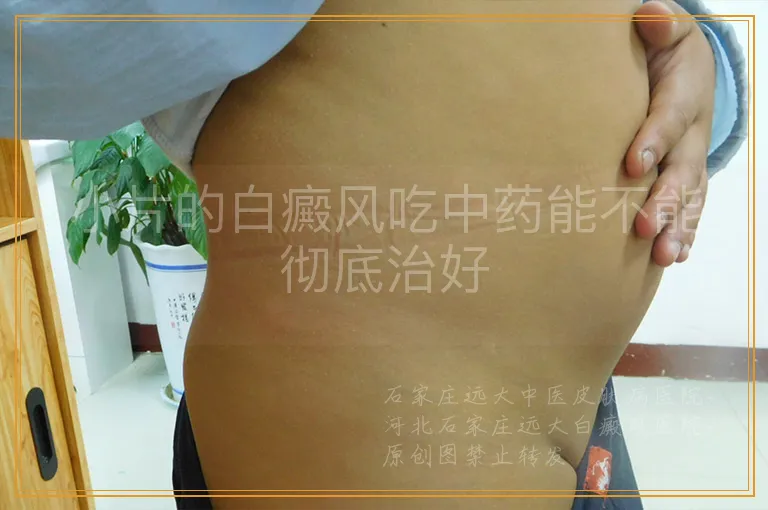 小片的白癜风吃中药能不能彻底治好