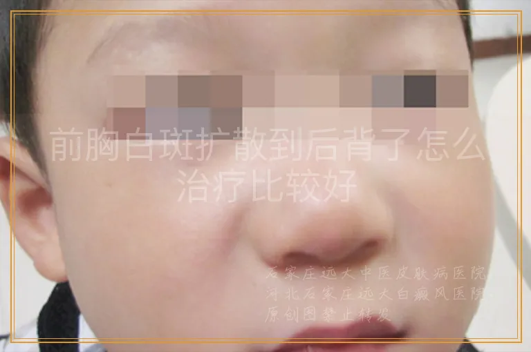 前胸白斑扩散到后背了怎么治疗比较好