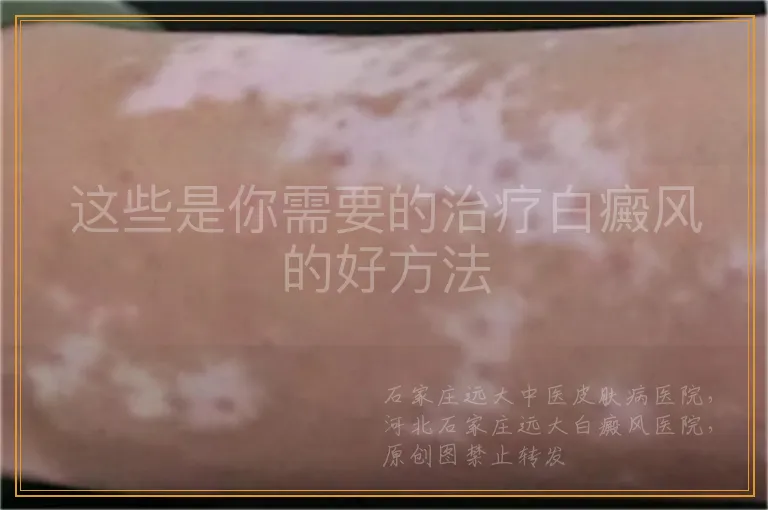 这些是你需要的治疗白癜风的好方法