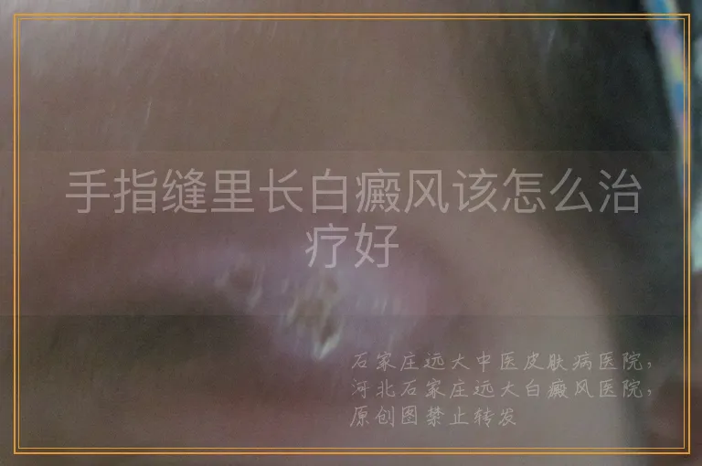 手指缝里长白癜风该怎么治疗好
