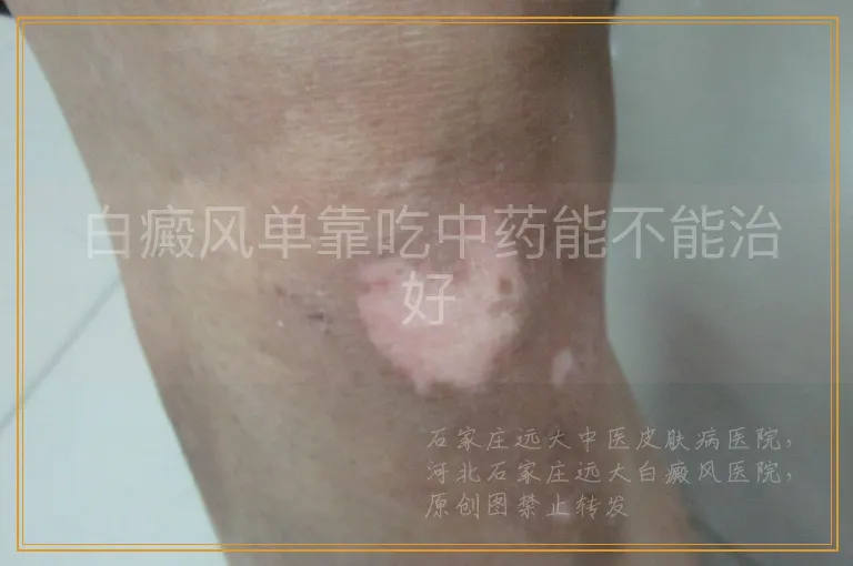白癜风单靠吃中药能不能治好