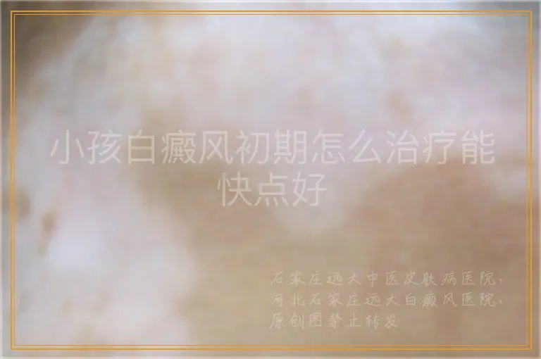 小孩白癜风初期怎么治疗能快点好