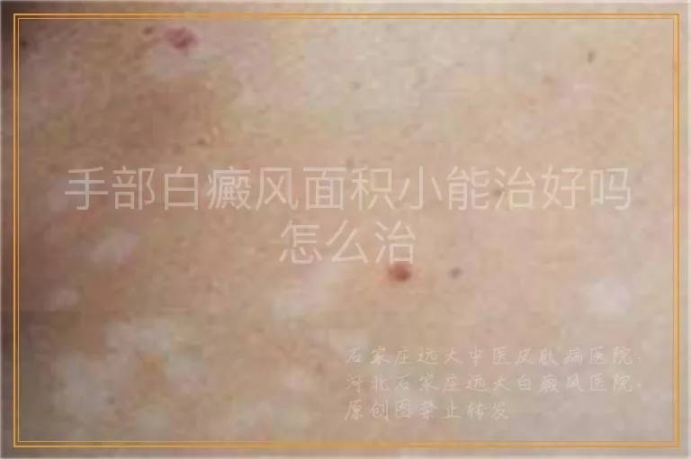 手部白癜风面积小能治好吗怎么治