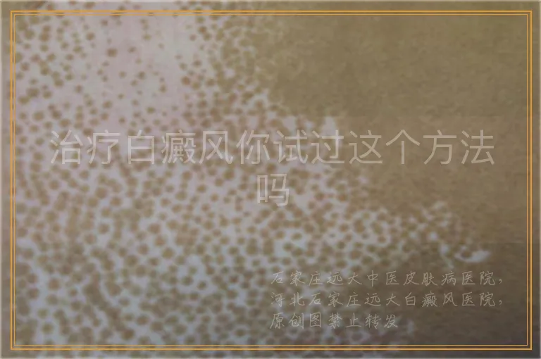 治疗白癜风你试过这个方法吗