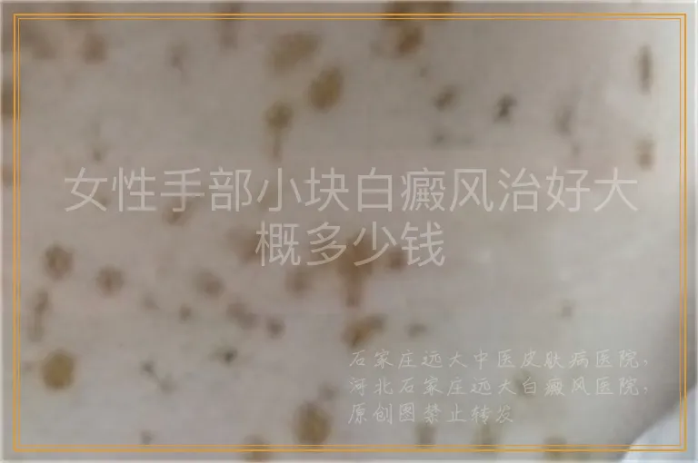 女性手部小块白癜风治好大概多少钱