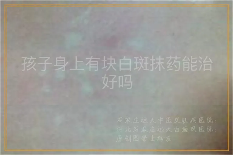 孩子身上有块白斑抹药能治好吗