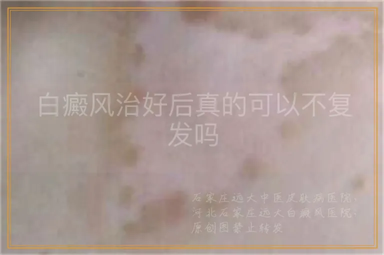 白癜风治好后真的可以不复发吗