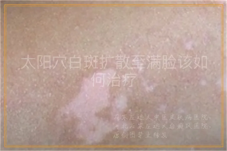 太阳穴白斑扩散至满脸该如何治疗