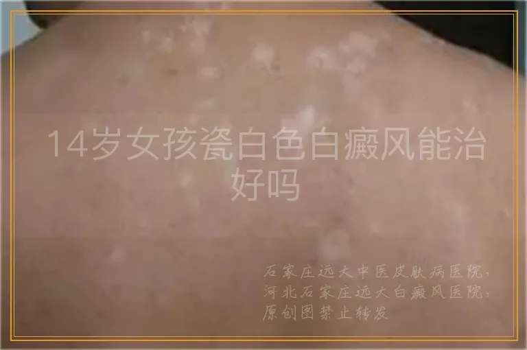 14岁女孩瓷白色白癜风能治好吗