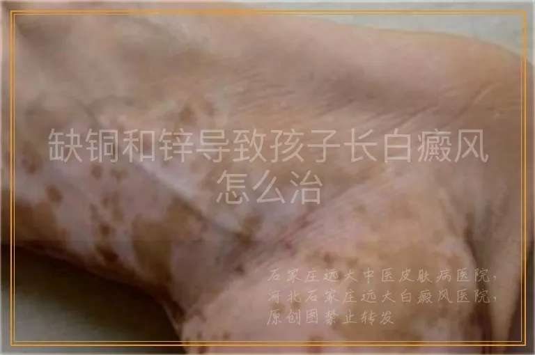 缺铜和锌导致孩子长白癜风怎么治
