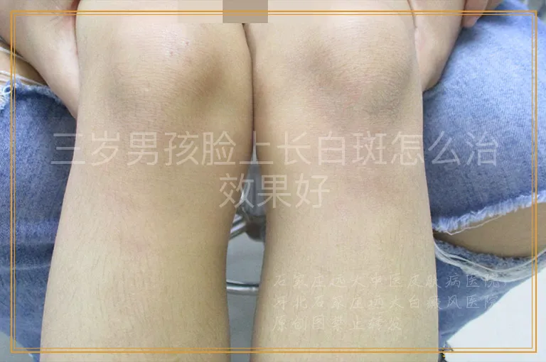 三岁男孩脸上长白斑怎么治效果好