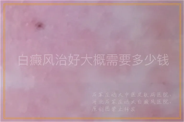 白癜风治好大概需要多少钱