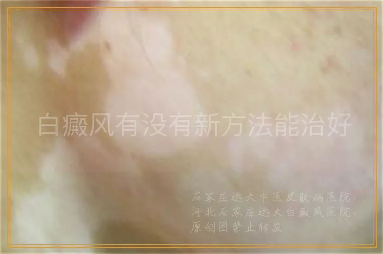 白癜风有没有新方法能治好