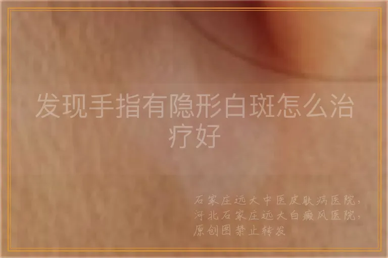 发现手指有隐形白斑怎么治疗好