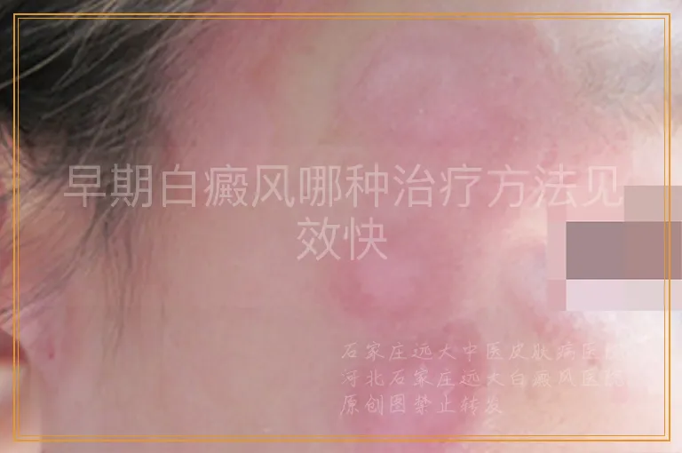 早期白癜风哪种治疗方法见效快
