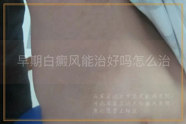早期白癜风能治好吗怎么治
