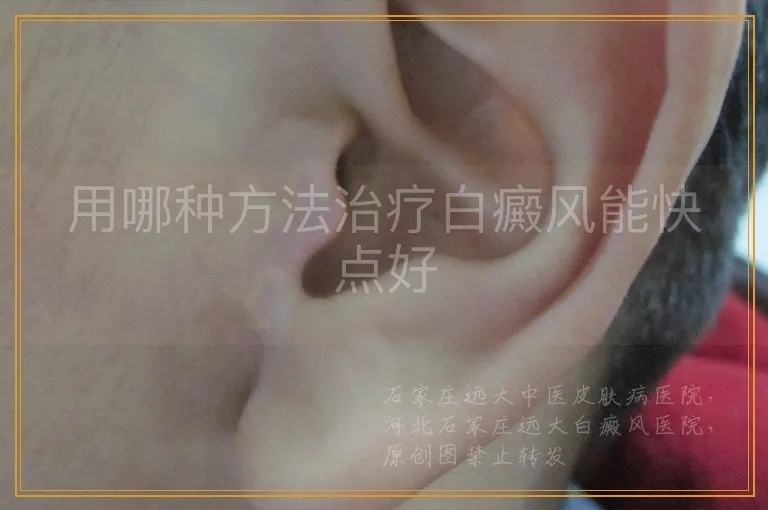 用哪种方法治疗白癜风能快点好